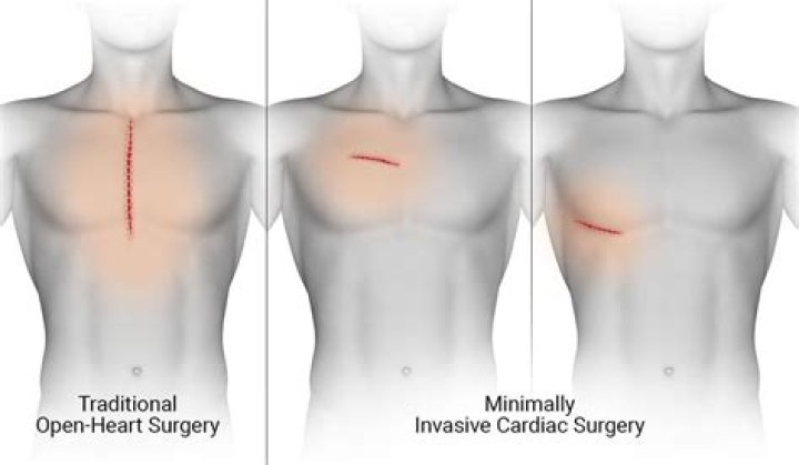 Celebrities And Heart Valve Surgery